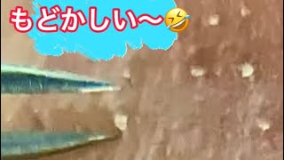 【角栓ピンセット】#毛穴#毛穴レス #毛穴ケア最後が....ピンセットで1つづつ 取る☝️