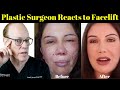 Plastic surgeon reacts  lorry hills facelift before  after