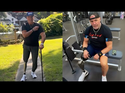 My First Steps On My New Prosthetic Leg