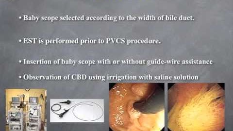 Diagnostic Peroral Video Cholangioscopy Is an Accurate Diagnostic Tool for Patients with...