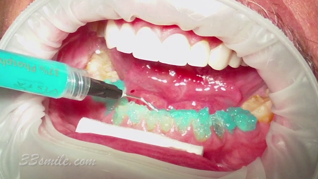 Video Procedures of Cosmetic Dentistry Treatment at Cosmetic Dental