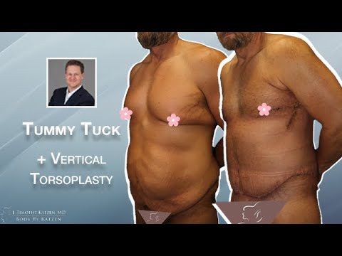 Tummy Tuck plus a Vertical Torsoplasty for a Male Patient Who Lost 140 lbs