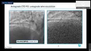 Webinar Series Topic 2 - Antegrade, uncrossable lesions, ADR