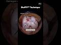 BioPFJ™ Knee Cartilage Restoration in the Operating Room