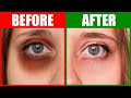 Fix the Root Cause of Dark Circles Under the Eyes Mp3 Song