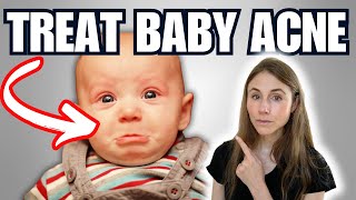 How To Treat Baby Acne On The Face: Dermatologist Tips