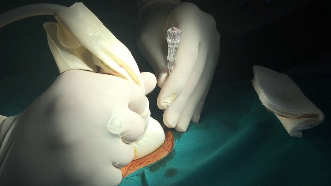 renal biopsy procedure - YouTube