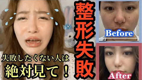 تحميل だんご鼻 整形 失敗