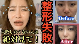 【鼻整形】鼻整形失敗しました。失敗したくない人は絶対見て！