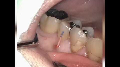 Sinus Tract Testing Revealed: A Game-Changer for Your Practice!