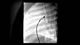 PDA device closure   Approximation of distal portion against ampulla