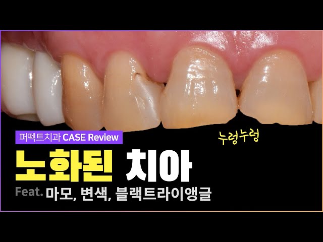 노화된 치아 마모,변색,블랙트라이앵글 | 복합적인 CASE💦
