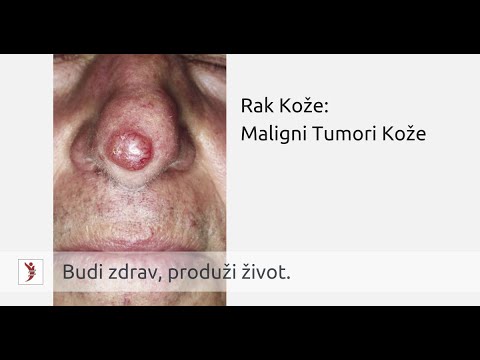 Video: Rak Kože (bazalni ćelijski Tumor) Kod Mačaka