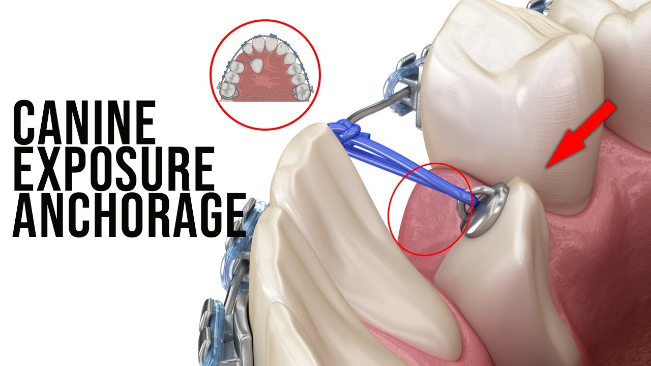 Using TPA and Piggy Back Technique Double Wire for Impacted Canine Exposure Anchorage