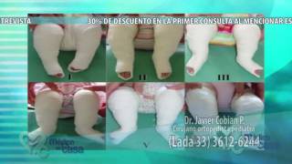 clubfoot