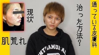 【ニキビ】治った方法？絶対にやってはいけないこと。