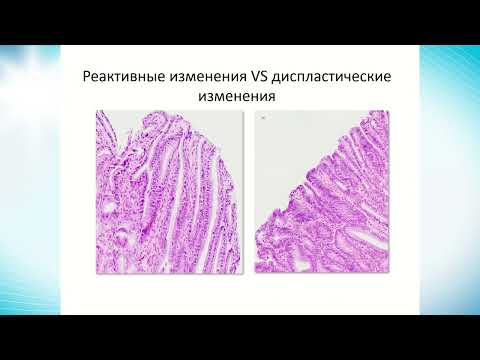 Оценка морфол.материала при эндоскоп.диаг.и малоинв. лечении ранних форм рака желудка. Крайнова Е.А.