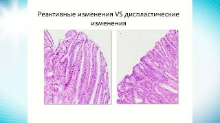 Оценка морфол.материала при эндоскоп.диаг.и малоинв. лечении ранних форм рака желудка. Крайнова Е.А.