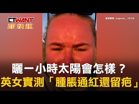 CTWANT 生活新聞 / 曬一小時太陽會怎樣？　英女實測「腫脹通紅還留疤」