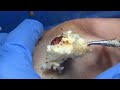 [ASMR] Sharp Ingrown Trimmed! Professional Pedicure DR LEE’S ULTIMATE ZITPOPPER 0509IPX IMG 3609
