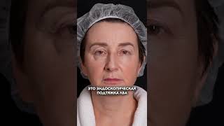 Эндоскопический лифтинг лба, бровей и средней зоны лица!