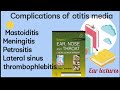 Complications of otitis media|Meningitis|Mastoiditis|Petrositis|| Ear dhingra lectures #ear#dhingra