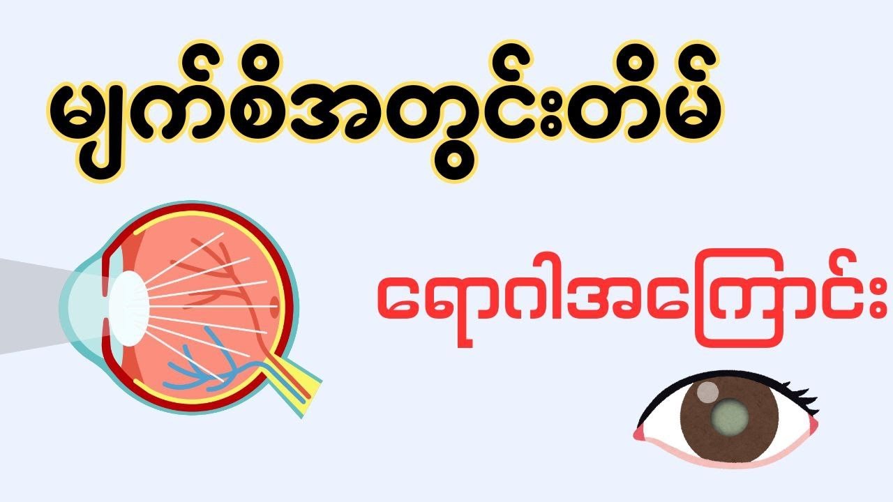 မျက်စိအတွင်းတိမ် ရောဂါအကြောင်း-cataract