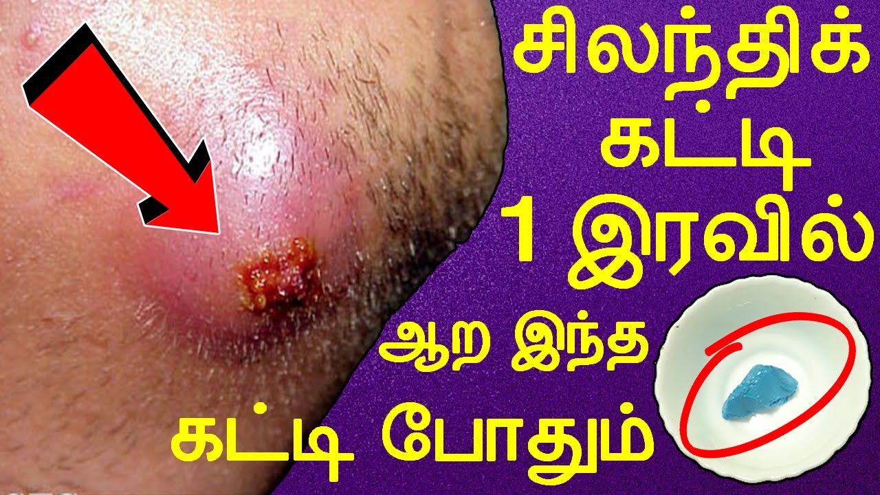 1 கட்டி போதும் சிலந்திக் கட்டி காணமல் போயிரும் | silanthi katti ...