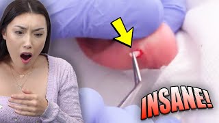 Her Earring Was STUCK For 13 Years!! *INSANE*