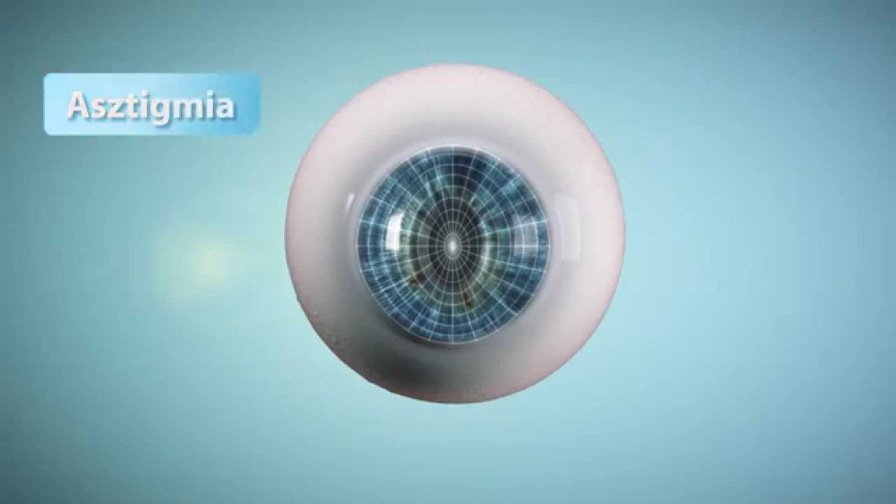 Myopia és hyperopia: tiszta látás szemüveg és kontaktlencse nélkül?