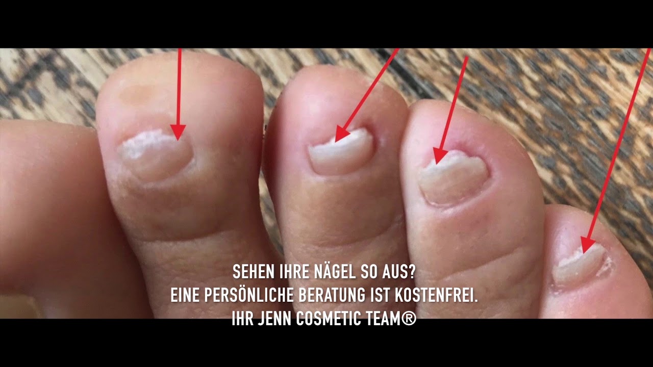 brüchige fußnägel bilder