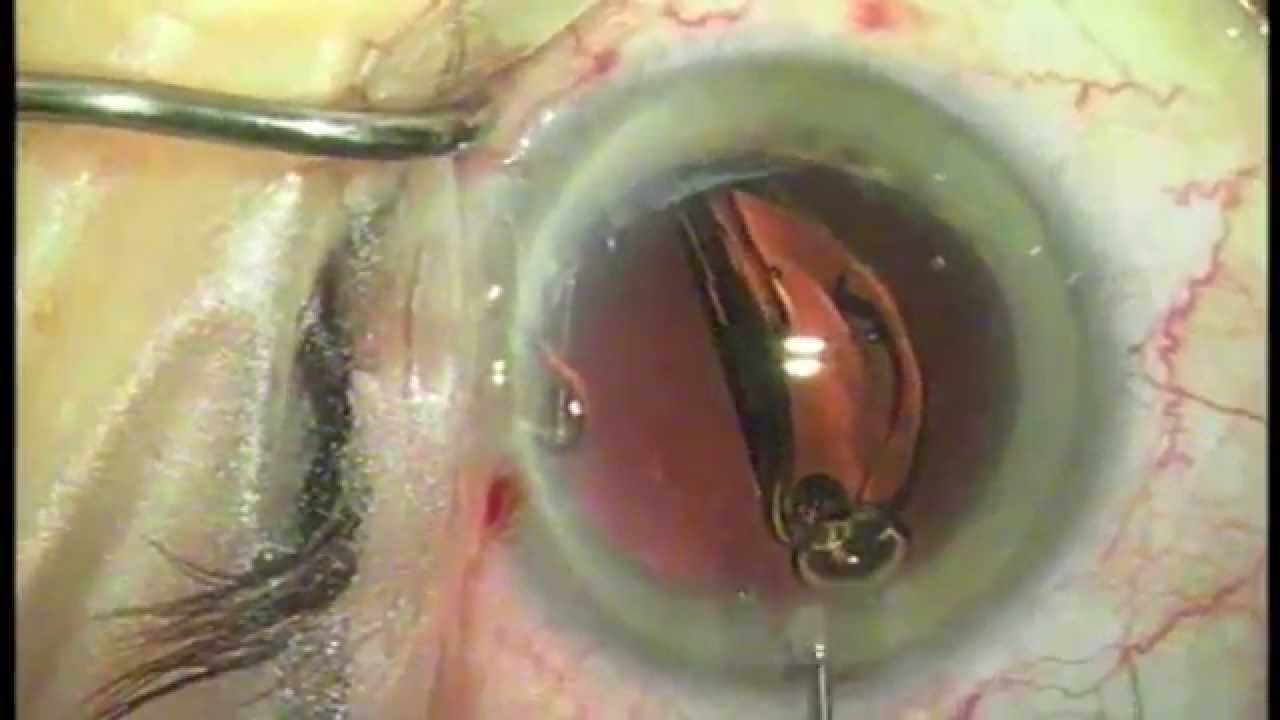 Ravi Goel MD Live Cataract Surgery Patient friendly (Wills Eye) YouTube
