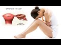 Laparoscopic Surgery for Torsion of Ovarian Cyst