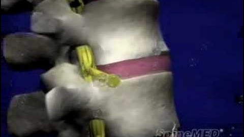 Spine Med Decompression.mov