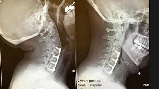 spine lecture:  nonunion anterior cervical spine