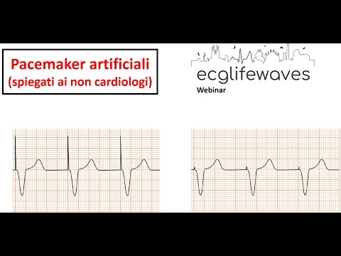 L&rsquo;ECG nel portatore di Pacemaker - ECGLIFEWAVES Webinar (a cura di Domenico Gruosso)