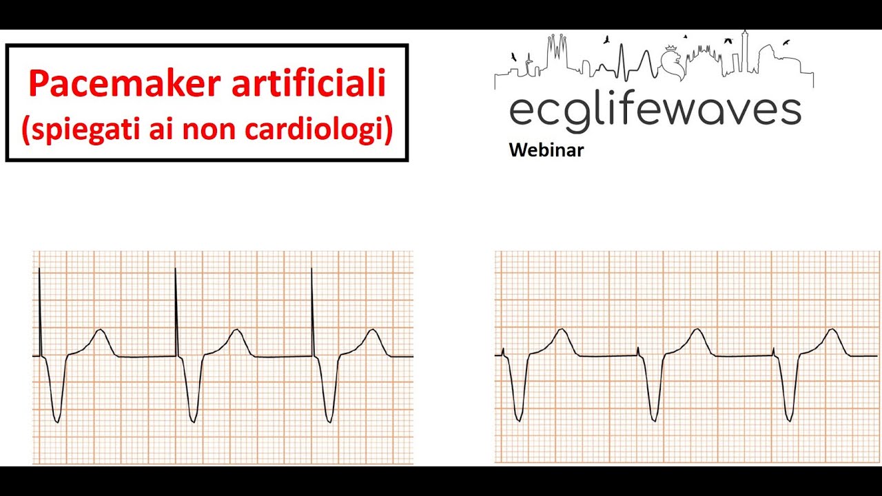 L'ECG nel portatore di Pacemaker - ECGLIFEWAVES Webinar (a cura di Domenico Gruosso)