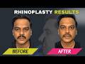 Rhinoplasty Testimonial with Dr Ashish Davalbhakta| Patient Experience