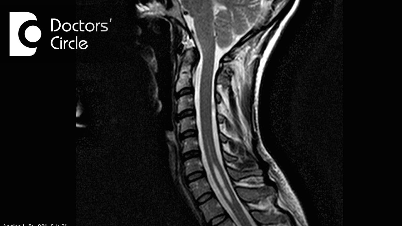Symptoms of Syringomyelia - Dr. Vykunta Raju K N