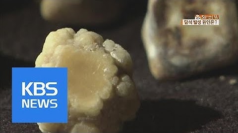 [5분 건강 톡톡] 쓸개에 생긴 돌 ‘담석증’…수술 여부는? / KBS뉴스(News)