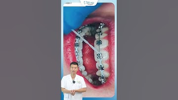 Đi Chun Chuỗi Trong Niềng Răng | Bác Sĩ Yên