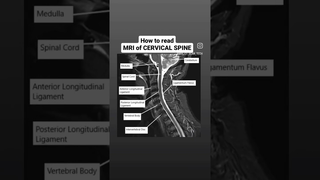 How to read MRI of Cervical Spine #viral #mri #shorts