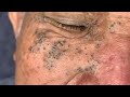 Dr pop   deep blackheads in old skin removing  treatment 2020 last part 10