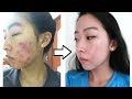 How I Cleared My Acne with ONE Product (NO ACCUTANE)