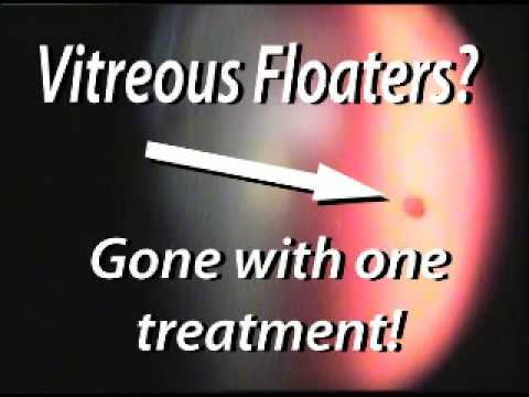 Vitreous Floater: Gone! Awesome Video [note: web site has changed 
