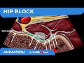 Hip Block - NYSORA's Reverse Ultrasound™ Animation