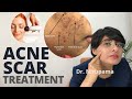 Acne scar removal video| Acne scar cream| Acne scar laser| Acne scar doctor| Acne scars kaise hataye