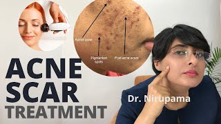 Acne scar removal video| Acne scar cream| Acne scar laser| Acne scar doctor| Acne scars kaise hataye