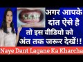 Sade Hue Dant Ka INaye Dant Lagane Ka Kharcha |Root Canal Treatment Step By Step |Teeth Cap Cost