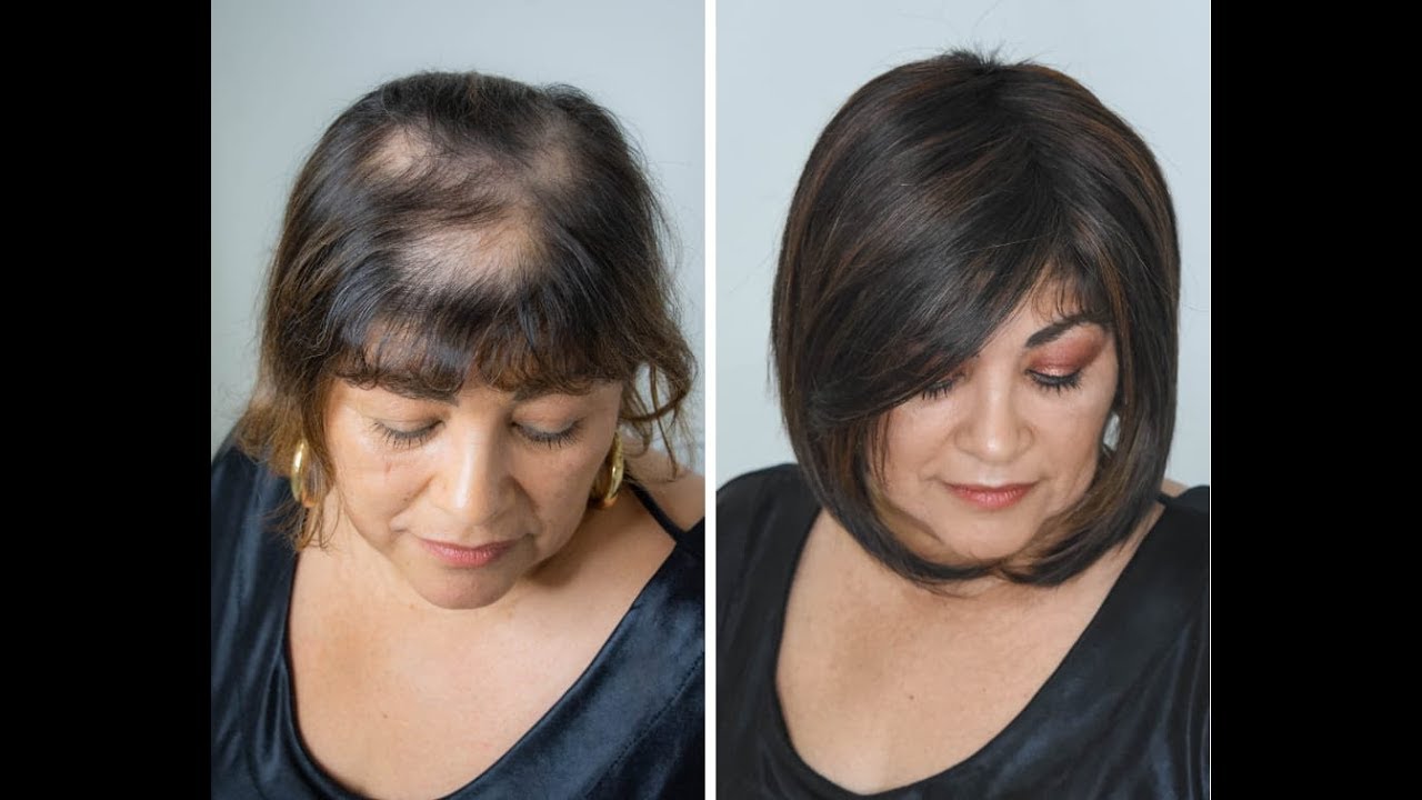 Preenchimento na região frontal, calvície e alopecia.